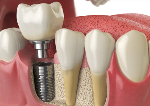 Dental Implants