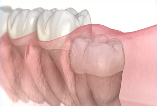 Impacted Teeth